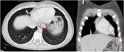 Interdisciplinary Radical “En-Bloc” Resection of Ewing Sarcoma of the Chest Wall and Simultaneous Chest Wall Repair Achieves Excellent Long-Term Survival in Children and Adolescents